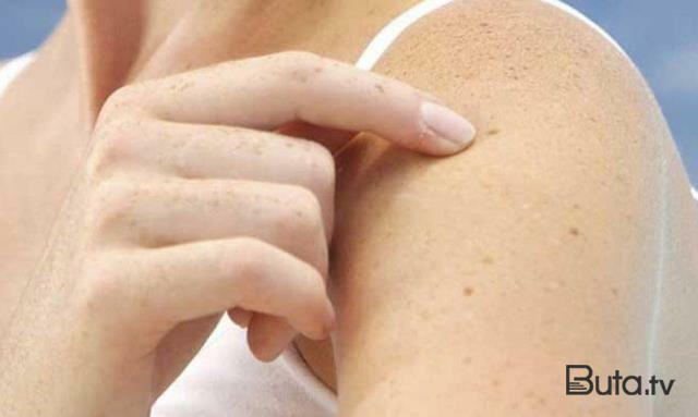  Qızılcaya yoluxmamaq üçün nə edilməlidir?  