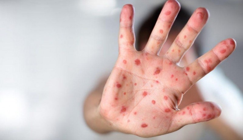  Ölkədə üç virus tüğyan edir - hepatit A, qızılca, suçiçəyi... 