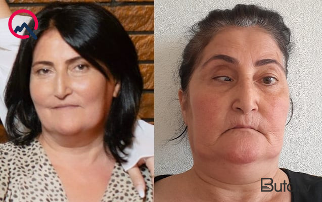 Bu klinika təzminat ödəyəcək - Burun düzəldəndə gözü zədələyib  